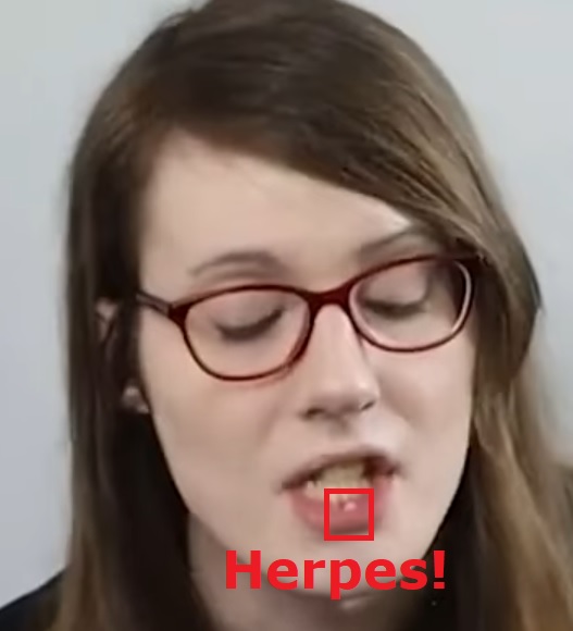 VivianHerpes.jpg